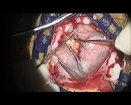 Awake Brain Surgery - Removal of metastatic brain tumor