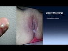 Normal Vaginal Discharge (Graphic Warning R18+)