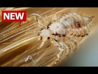 How to Get Rid of Lice Fast, Head Lice Treatment, Best Home Remedies for Lice, How to Kill Lice