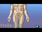 Hip Replacement Surgery PreOp® Patient Education Medical Videos