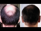 regrow hair naturally for men - how to regrow hair on bald spots