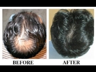 hair regrowth for men naturally - hair regrow naturally