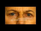Eyelid Cancer Surgery - Dr. Hüseyin Aral - Germany - LidMed